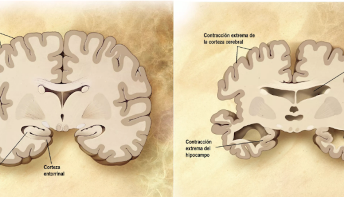 Revelan que las infecciones causadas por hongos pueden provocar síntomas de alzhéimer