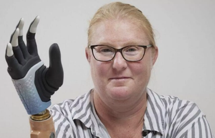 Video: Una mujer recibe la mano biónica revolucionaria que se fusiona con sus huesos, músculos y nervios