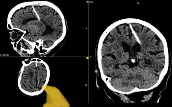 Una anciana de 80 años vivió toda su vida con una aguja en el cerebro