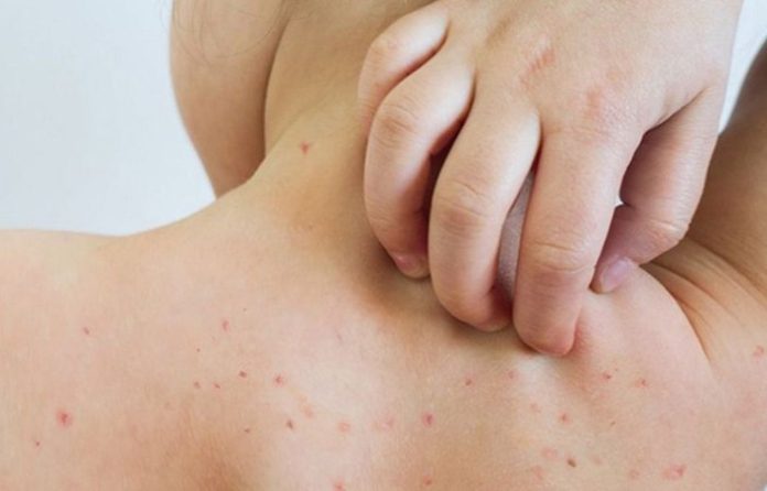 México suma al menos 14 fallecimientos a causa del sarampión