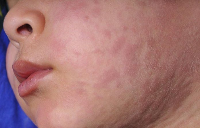 Paraguay se encuentra en alerta ante brote de sarampión en la región