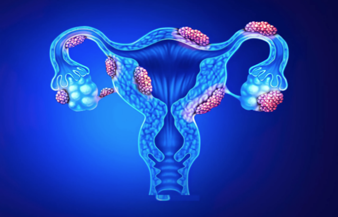 Compañía israelí inicia ensayo clínico para curar la endometriosis
