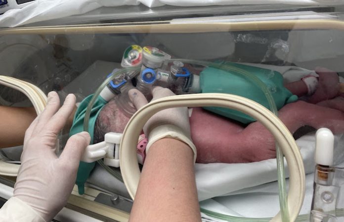 Nacen siamesas en el Hospital Regional Materno Infantil