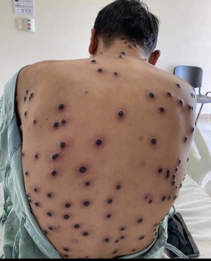 Primer caso de Mpox reportado fuera de África en Suecia; la OMS declara una emergencia mundial