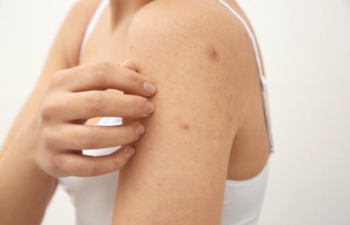 Los casos de sarna se disparan en Gran Bretaña en los últimos meses