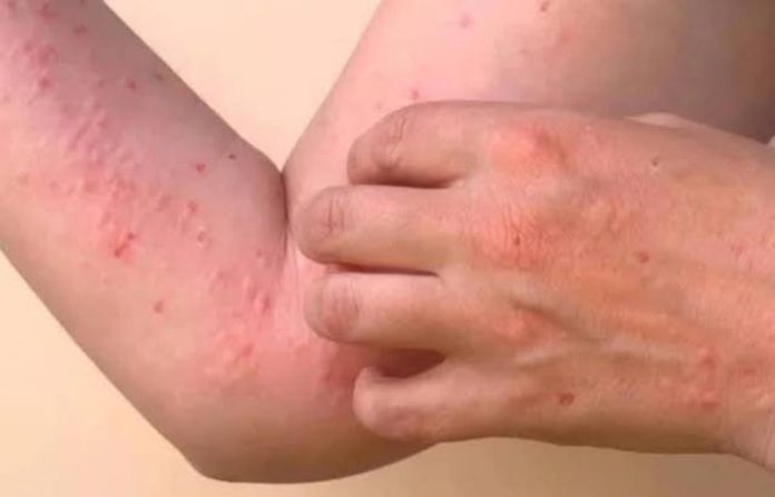 Francia enviará 120 soldados a La Reunión para ayudar a combatir el brote de chikunguña