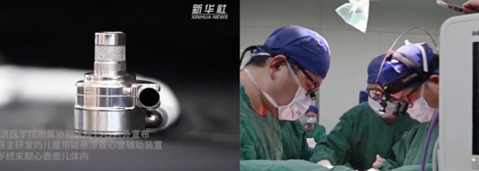Video (CH)Médicos chinos implantan el corazón artificial más pequeño del mundo a un niño de 7 años