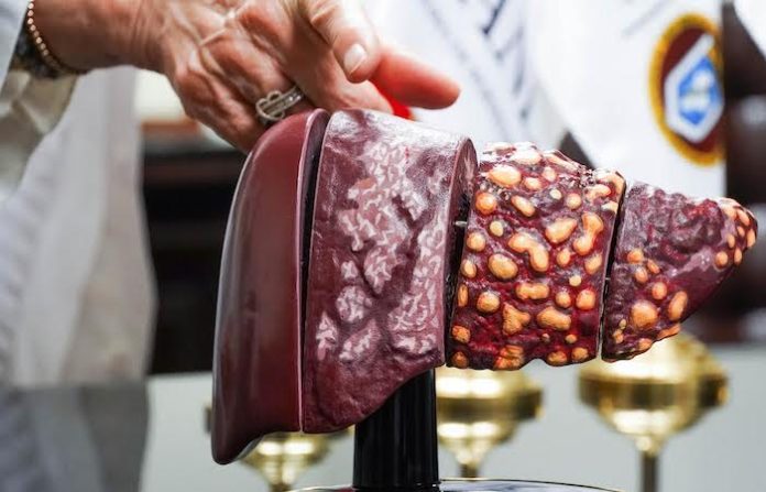 Hospital Universitario refuerza batalla contra hepatitis: la meta es erradicarla en 2030