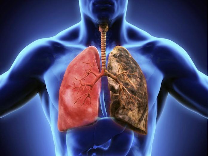 Casi la mitad de los pacientes con cáncer de pulmón en EU no reciben tratamiento, según estudio