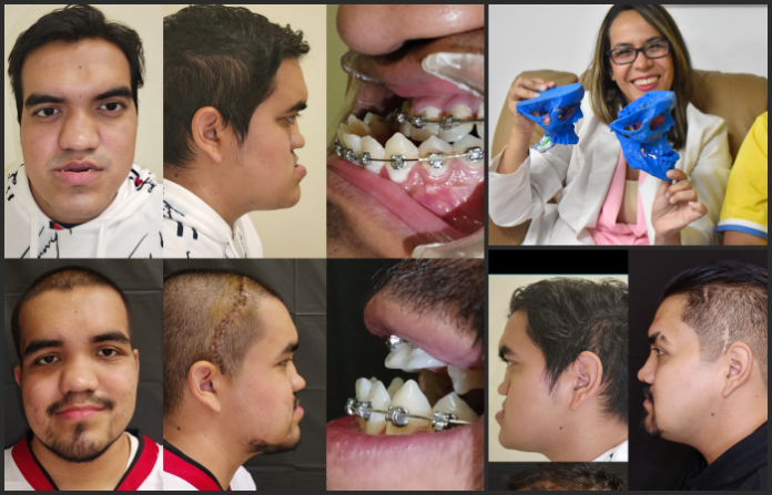 Después de 25 años de rechazo, médicos del IMSS reconstruyen el rostro de un joven y le cambian la vida